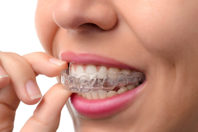 Transparent Aligners Cost: Get Details on Everything You Need to Know