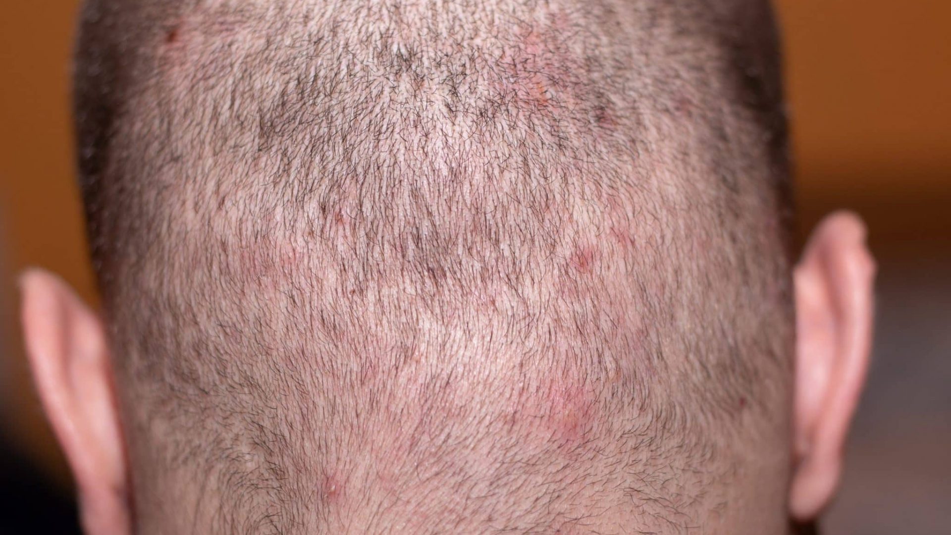 The Common Causes of Scalp Inflammation and Bumps The Common Causes of Scalp Inflammation and Bumps