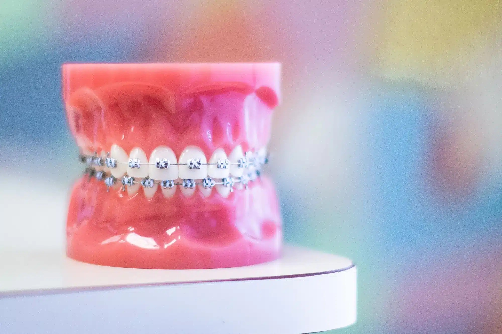 Why Orthodontists Still Choose Metal Braces for the Hardest Cases